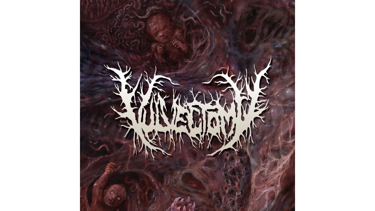 Vulvectomy